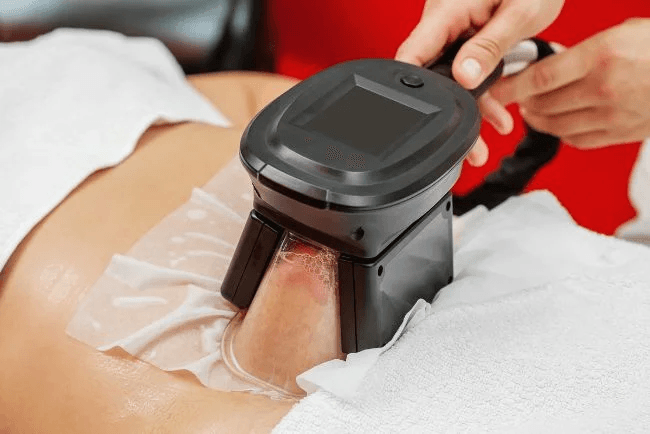 Kryolipolyse: Die innovative Methode zur Fettzellenbehandlung mit Kälte